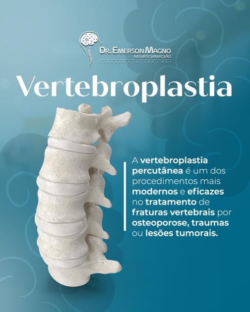 Vertebroplastia percutânea: alívio rápido para fraturas da coluna